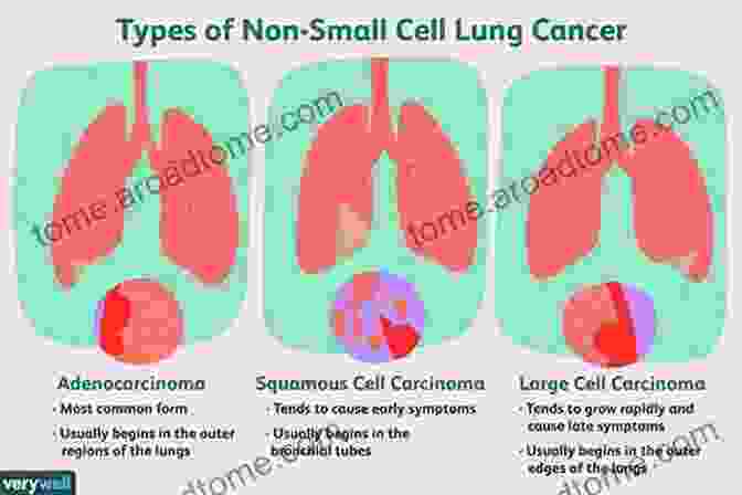 Types Of Lung Cancer Early Stage Lung Cancer: Screening And Management