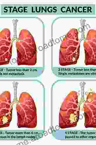 Early Stage Lung Cancer: Screening And Management